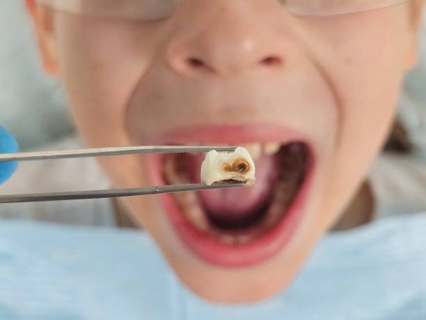 Best Emergency Wisdom Teeth Removal in Irondale, GA